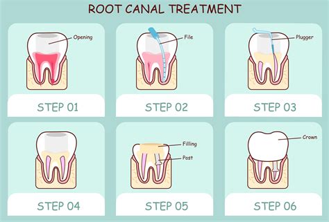 how to know if you need a root chanel|root canal procedure explained.